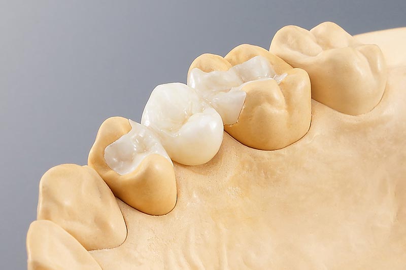 Dental Milling Solutions - bridge