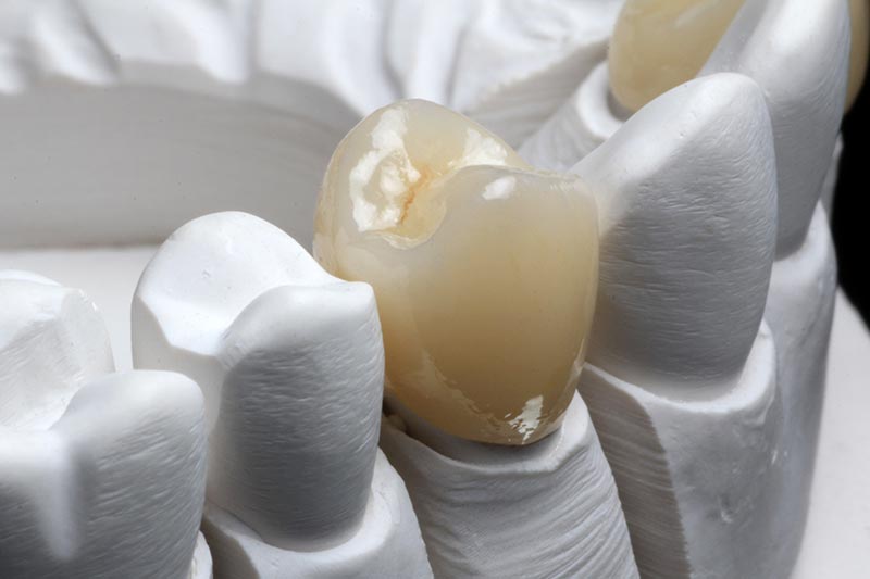 Dental Milling Solutions - crown