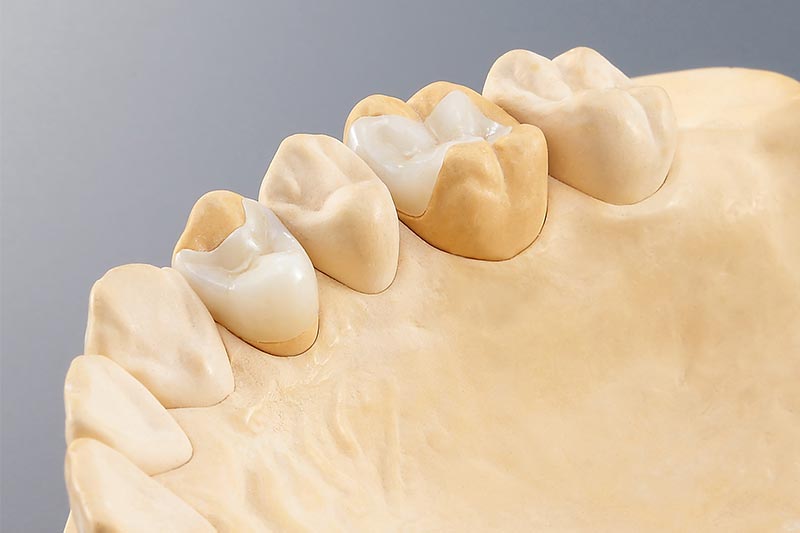 Dental Milling Solutions - inlay onlay