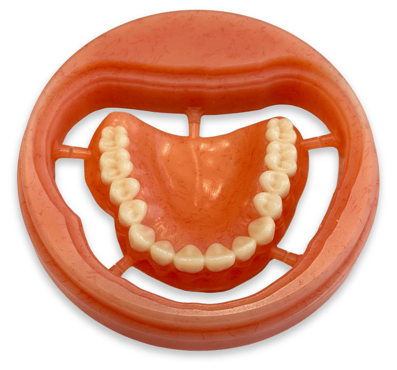 2-Step Overdenture in milled adapter using Ivotion Base and Dent Multi pucks