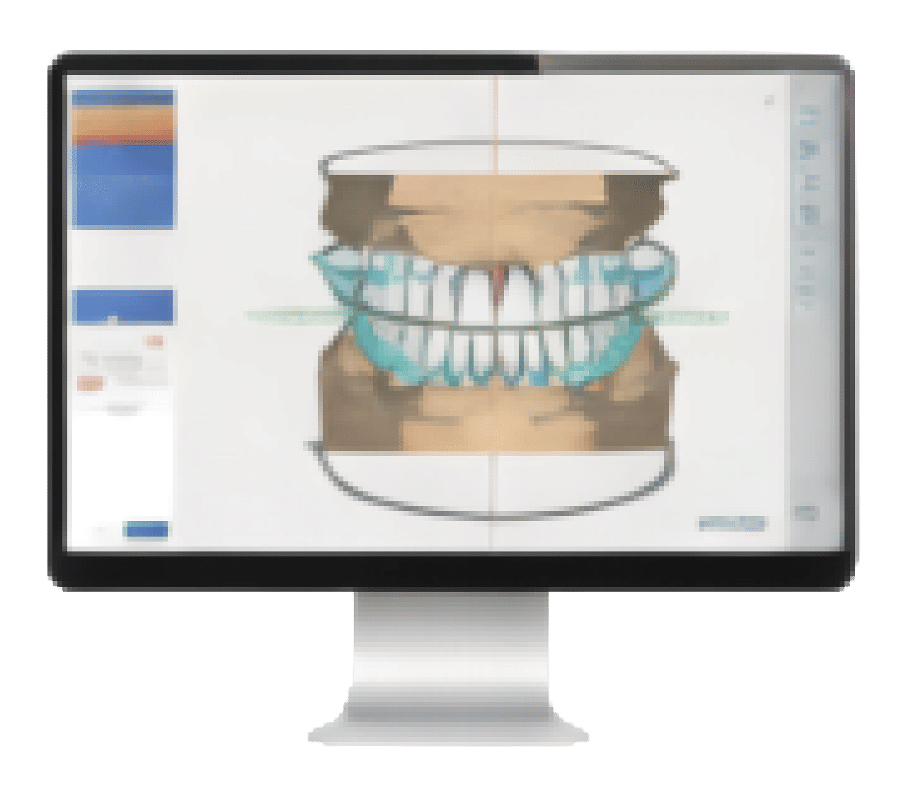 3shape denture preview